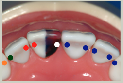 Mx Intercuspation Mx Lateral Incisors.png